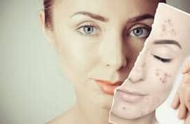 Remplacement du Botox