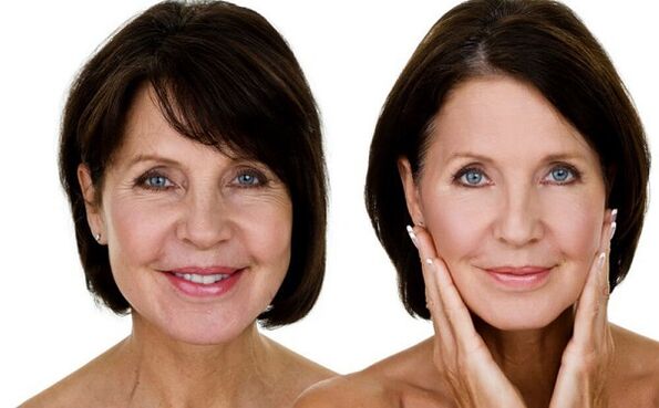 Avant et après le rajeunissement de la peau du visage à domicile.